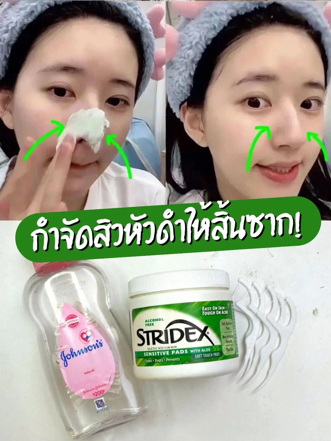 Get Rid Of The Blackheads Gallery Posted By Katty Lemon8