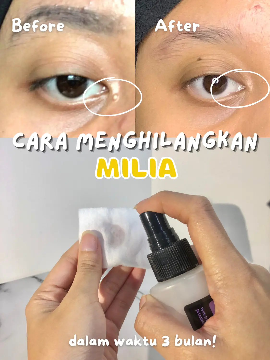 Cara Menghilangkan Milia dalam Waktu 3 Bulan Galeri diposting oleh