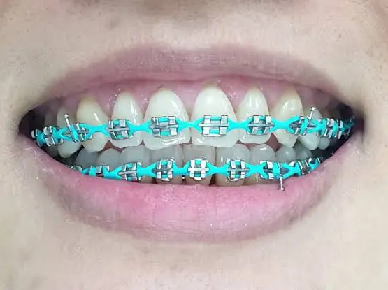 อัปเดต 25 สียางดัดฟันยอดนิยม | Bộ Sưu Tập Do Sutida S🌻 Đăng | Lemon8