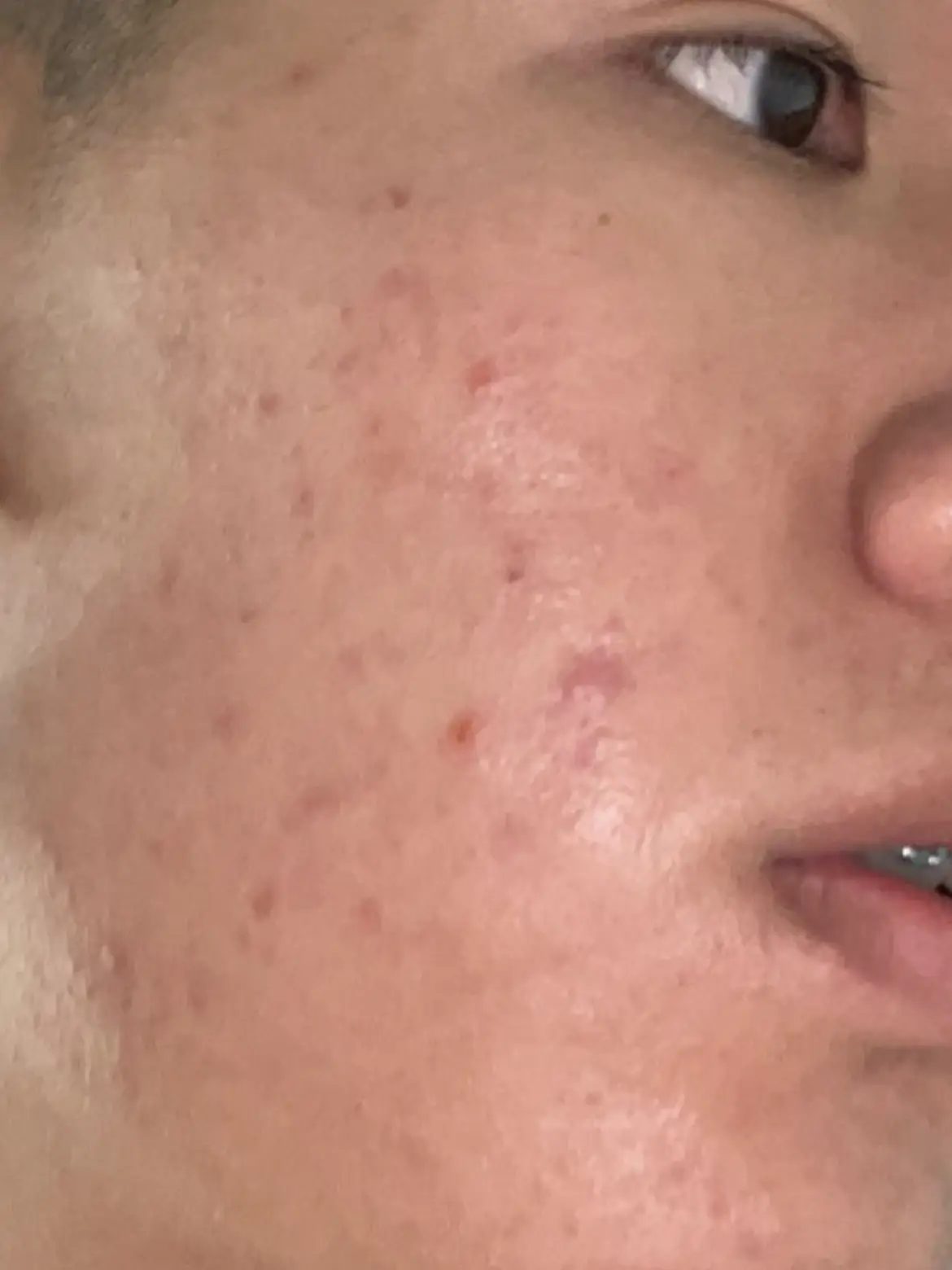 How I got rid of my acne's images(2)