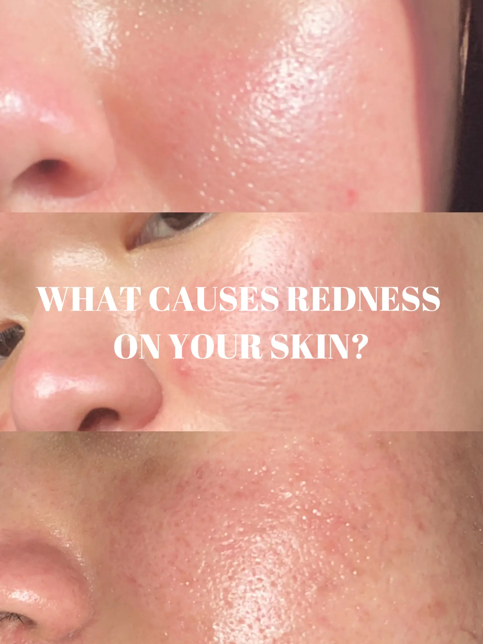 what-causes-redness-on-your-skin-gallery-posted-by-ayza-roslan