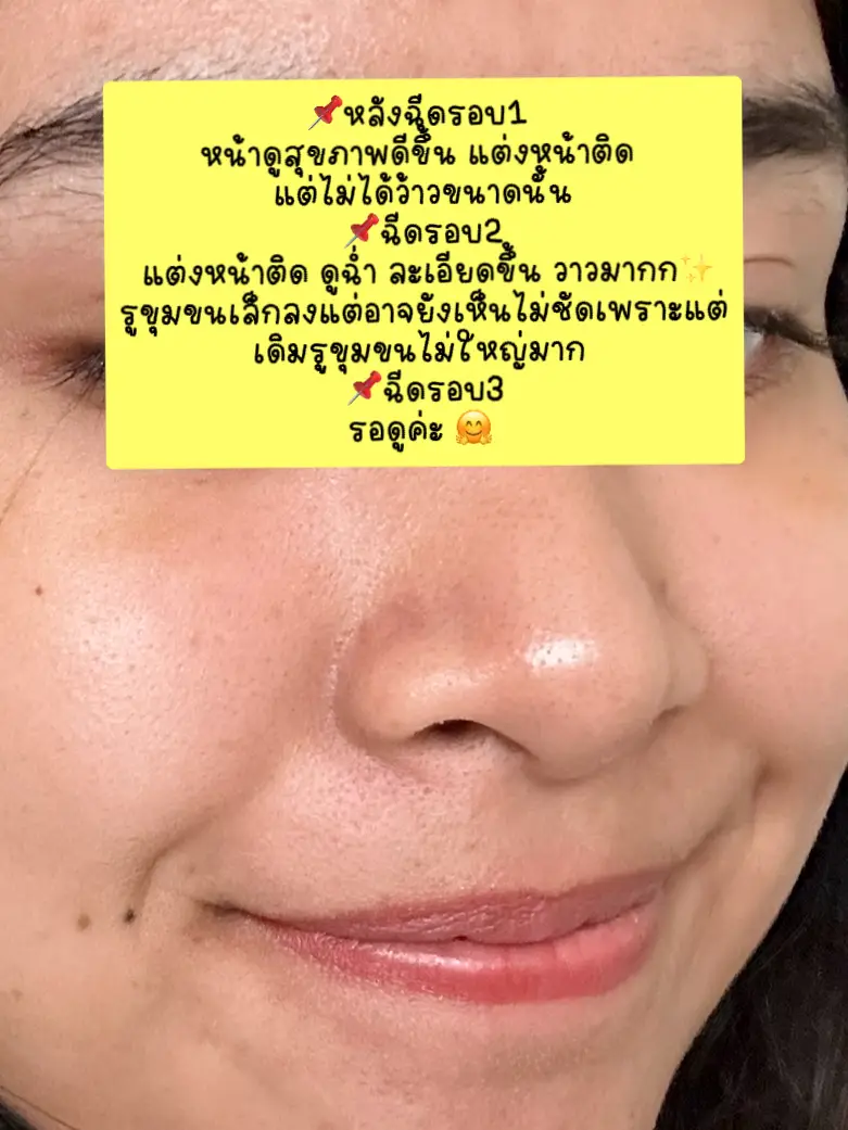 Rejuran 2cc ทั้งสองรอบ ดีจริงหรือตามกระแส🎉 | แกลเลอรีที่โพสต์โดย ...