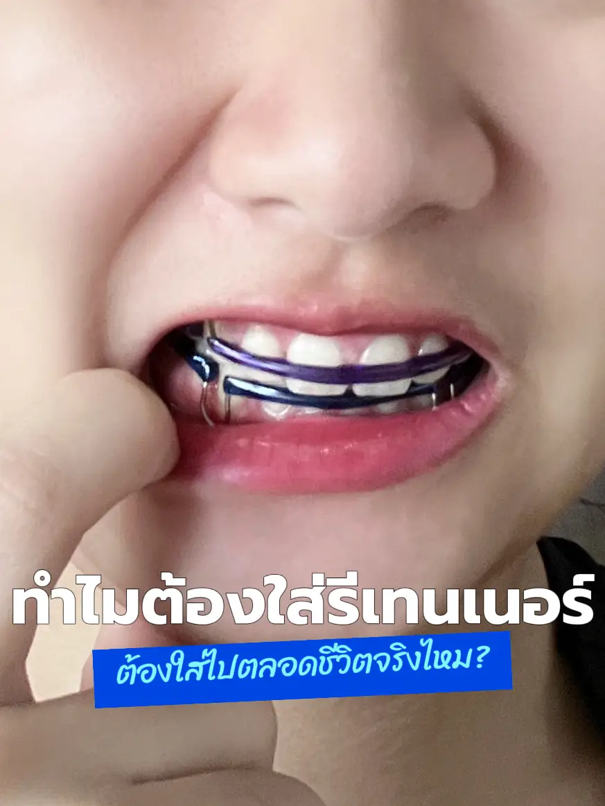 ต้องใส่รีเทนเนอร์ตลอดชีวิตจริงไหม? | แกลเลอรีที่โพสต์โดย Something_like ...