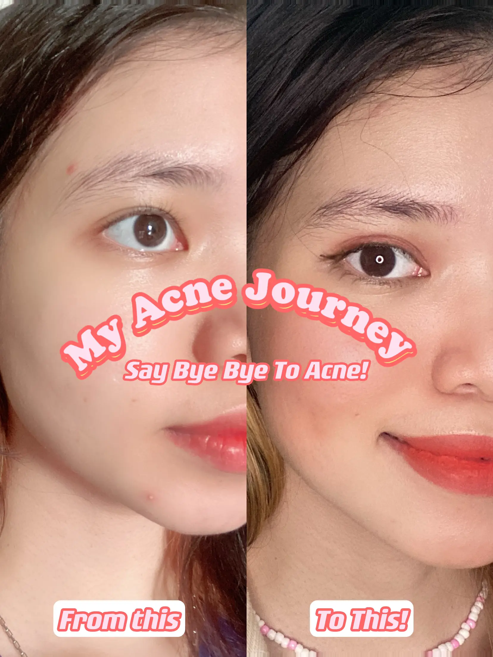 NEW Cleanance Women  Say good bye to acne 👋 Introducing