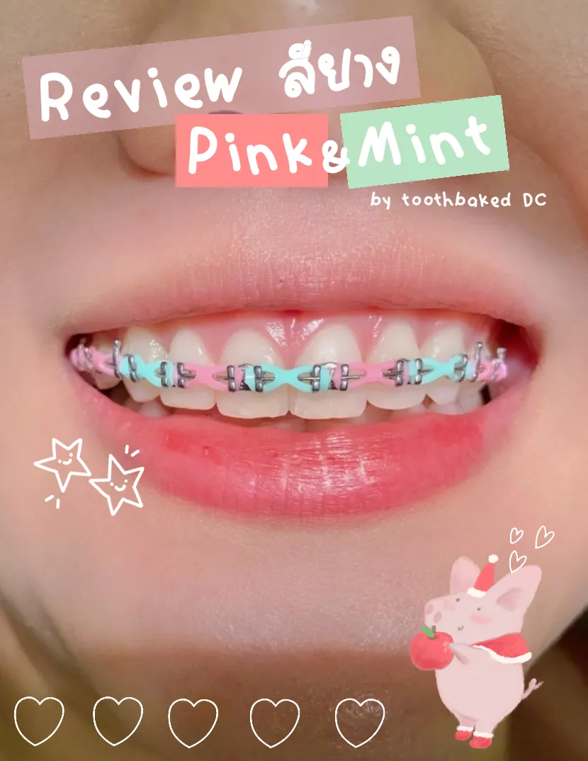 🍭 Rubber color pink & mint 🍬 | Gallery posted by Toothbaked​DC | Lemon8