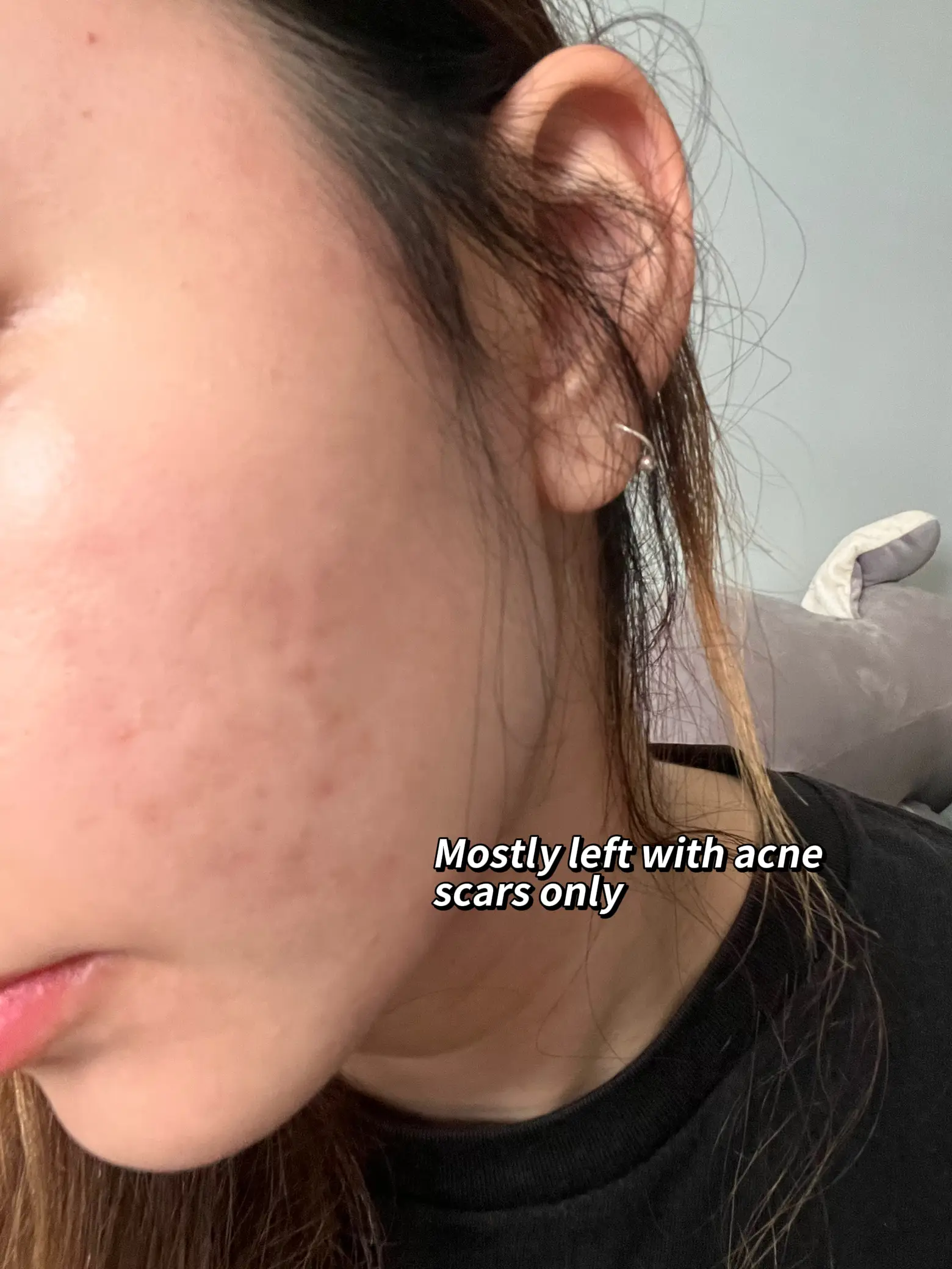 ACCUTANE DOOP THAT FINALLY CLEARED MY SEVERE ACNE🥹's images(4)