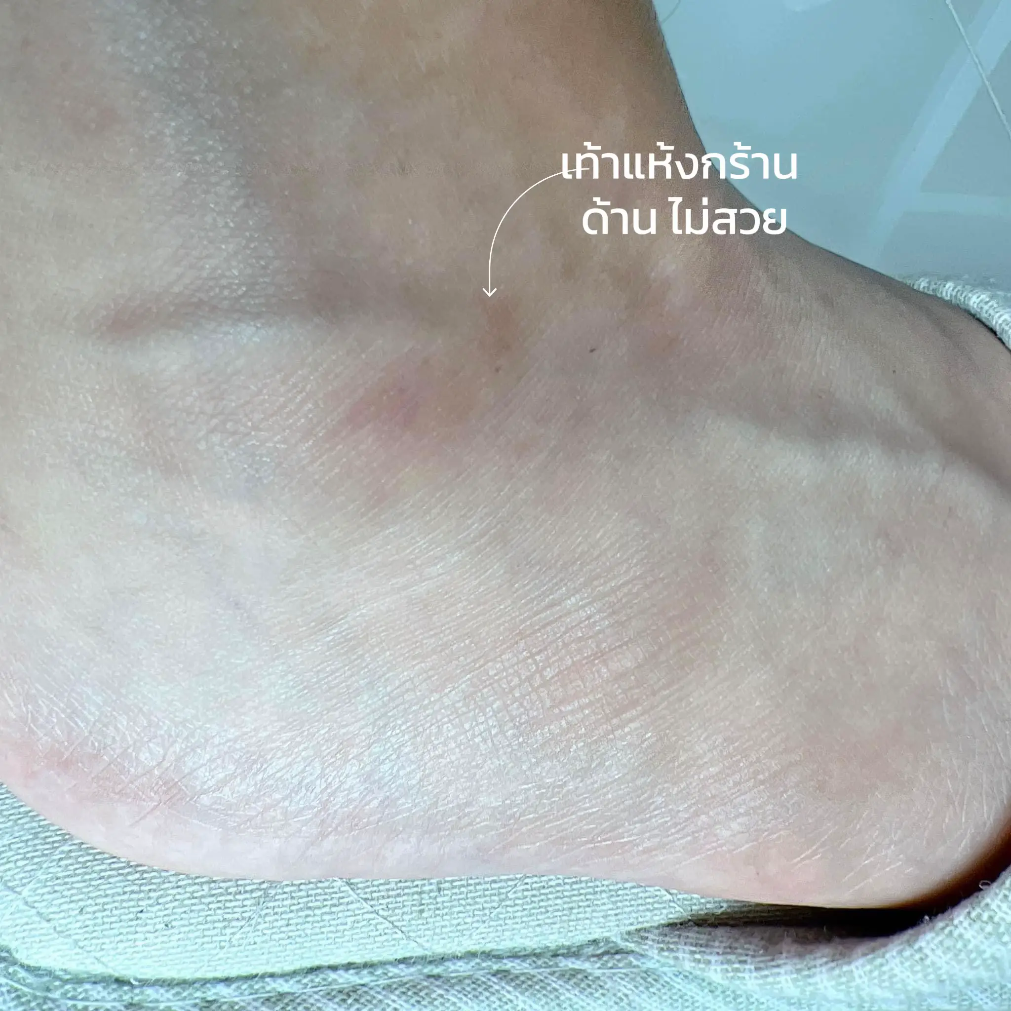 Dry feet, matte skin, unattractive skin, waved thick. Your feet are coming.  | Gallery posted by 𝙼𝚎𝚕𝚘𝚍𝚢 | Lemon8