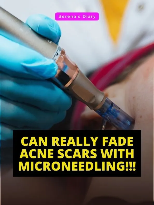 can-fade-acne-scars-with-microneedling-gallery-posted-by-serena-s