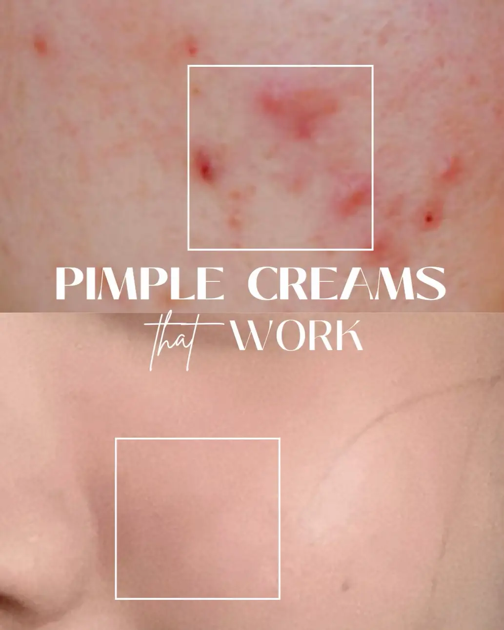 Pimple Creams That WORKS 🥹✨'s images(0)