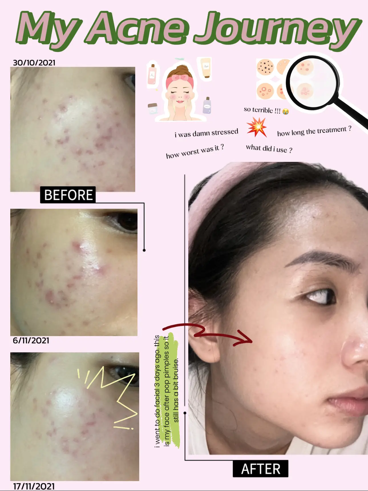 How i cleared my acne ❌❌❌ 🥹🥹🥹's images(0)