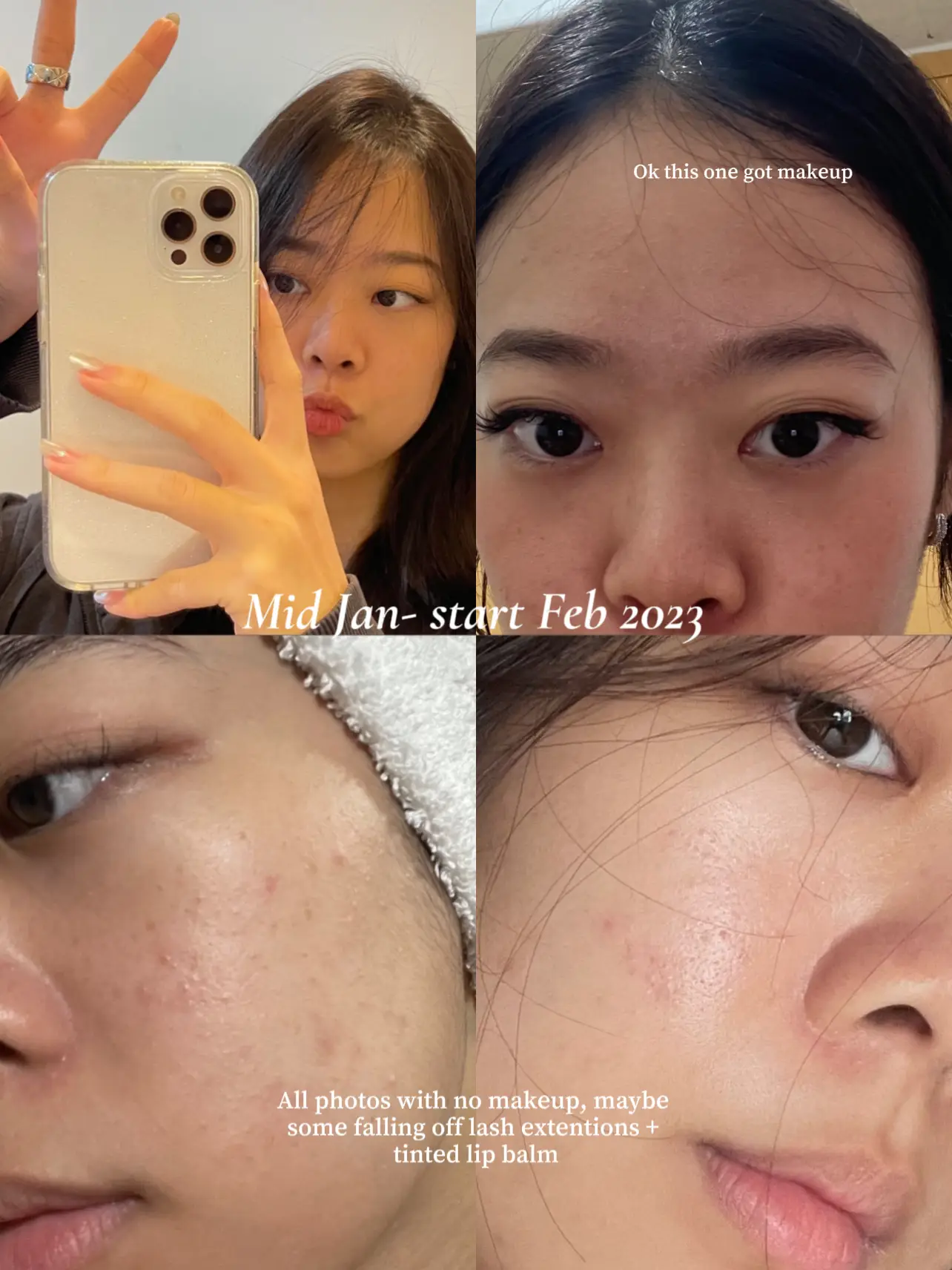 I finally cleared up my acne... 😭🧿's images(2)