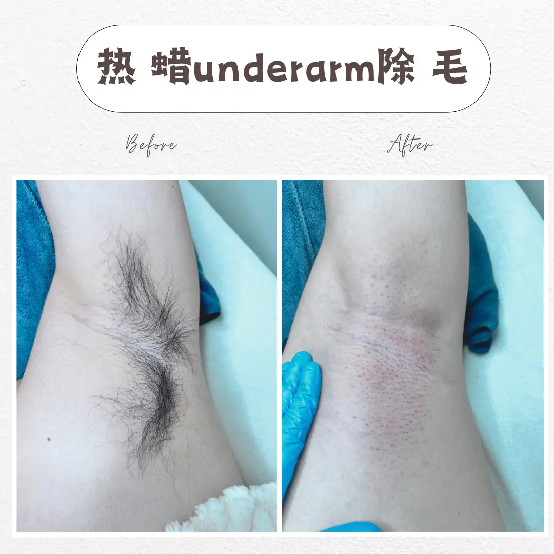 underarm waxing before and after