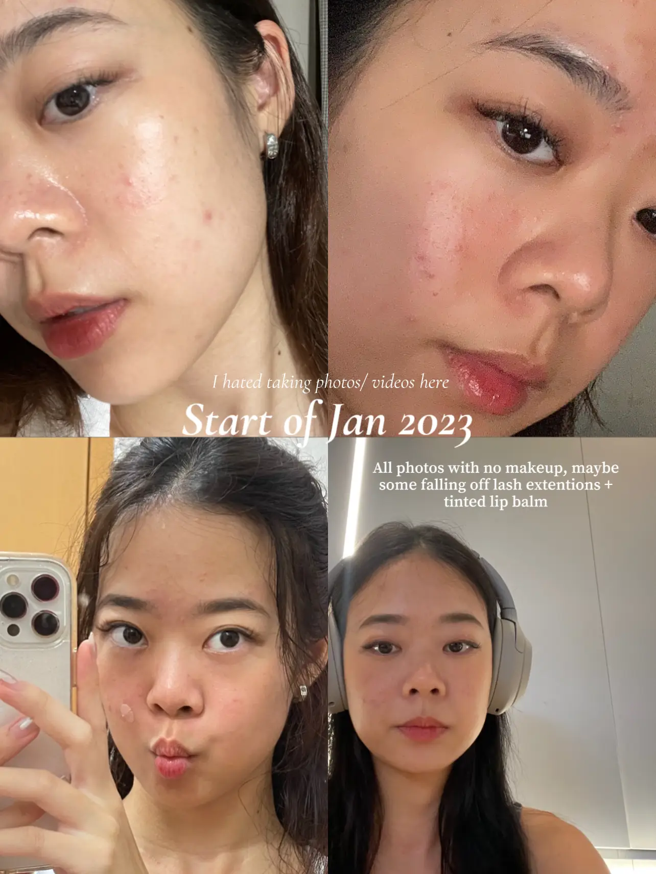 I finally cleared up my acne... 😭🧿's images(1)