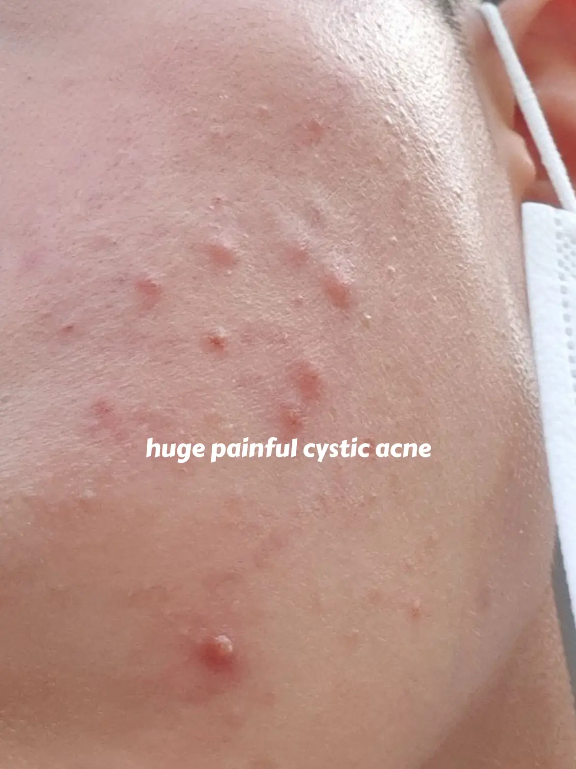 How I got rid of my acne's images(1)