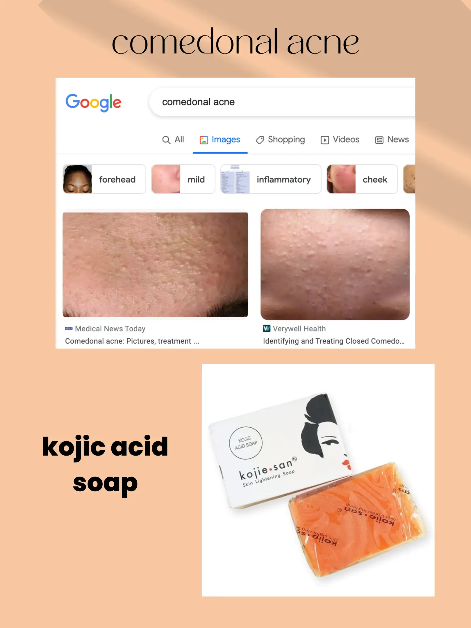 Using ACID SOAP for ACNE (my skincare journey)'s images(1)