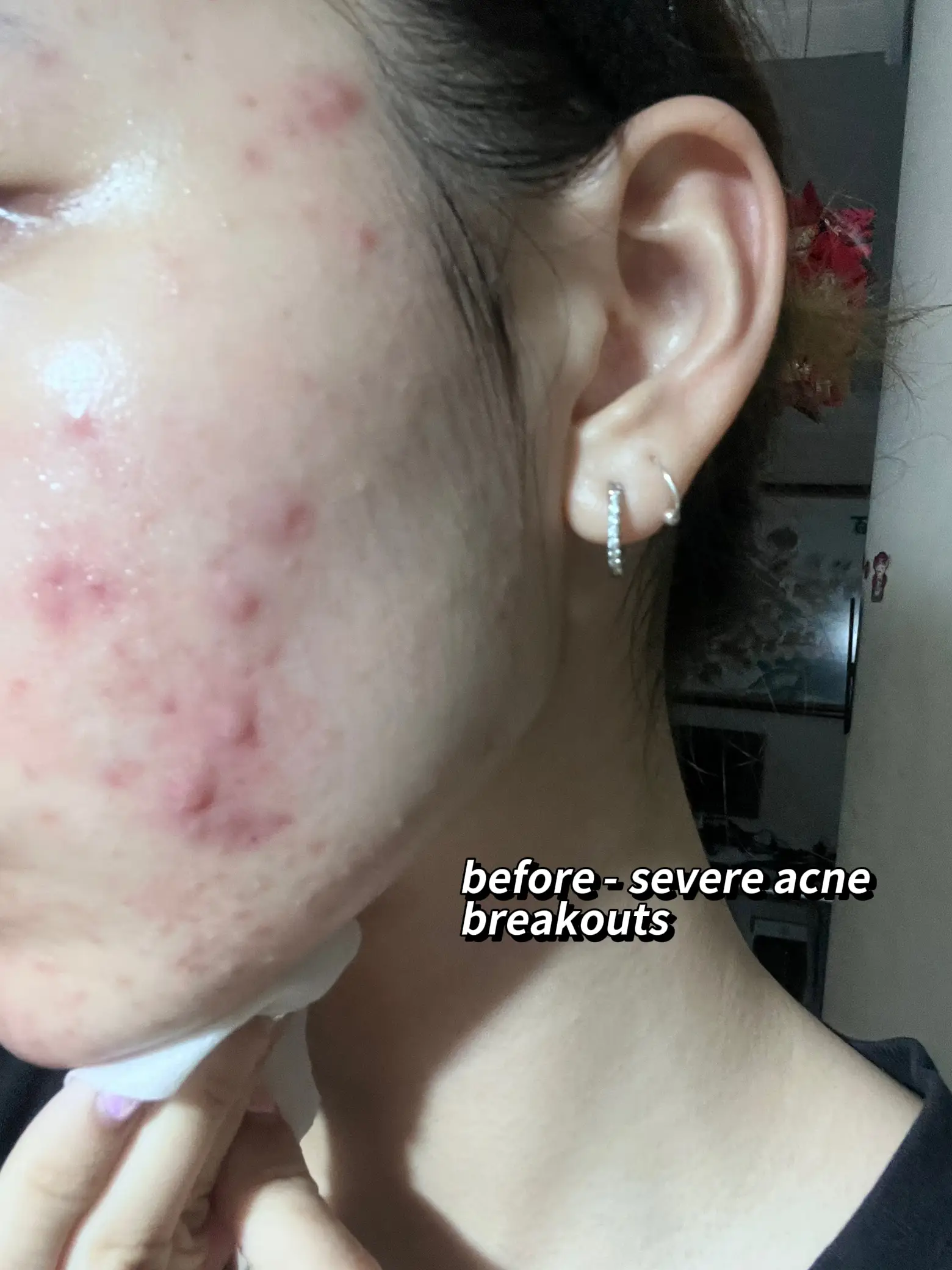ACCUTANE DOOP THAT FINALLY CLEARED MY SEVERE ACNE🥹's images(2)