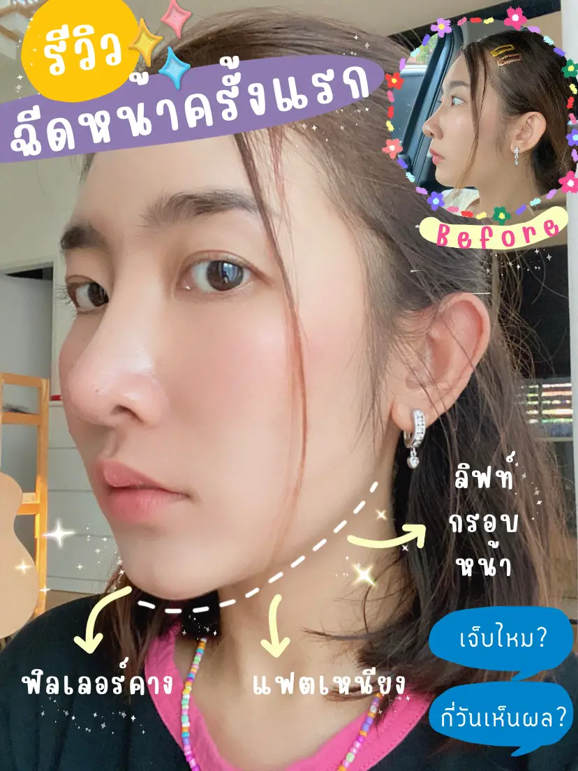 First face injection!!!When I want a small slender face like my  mother!!💖, Gallery posted by Alicechibi🪄