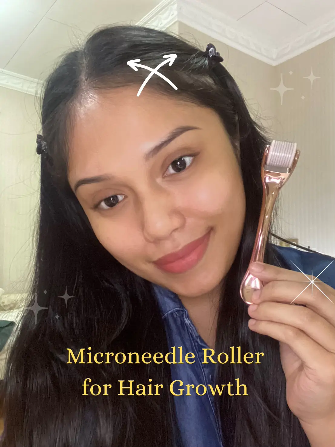 Proper Method: Microneedle Roller for Hair Growth👩🏻 | Video diterbitkan  oleh Dhiya Dhina | Lemon8