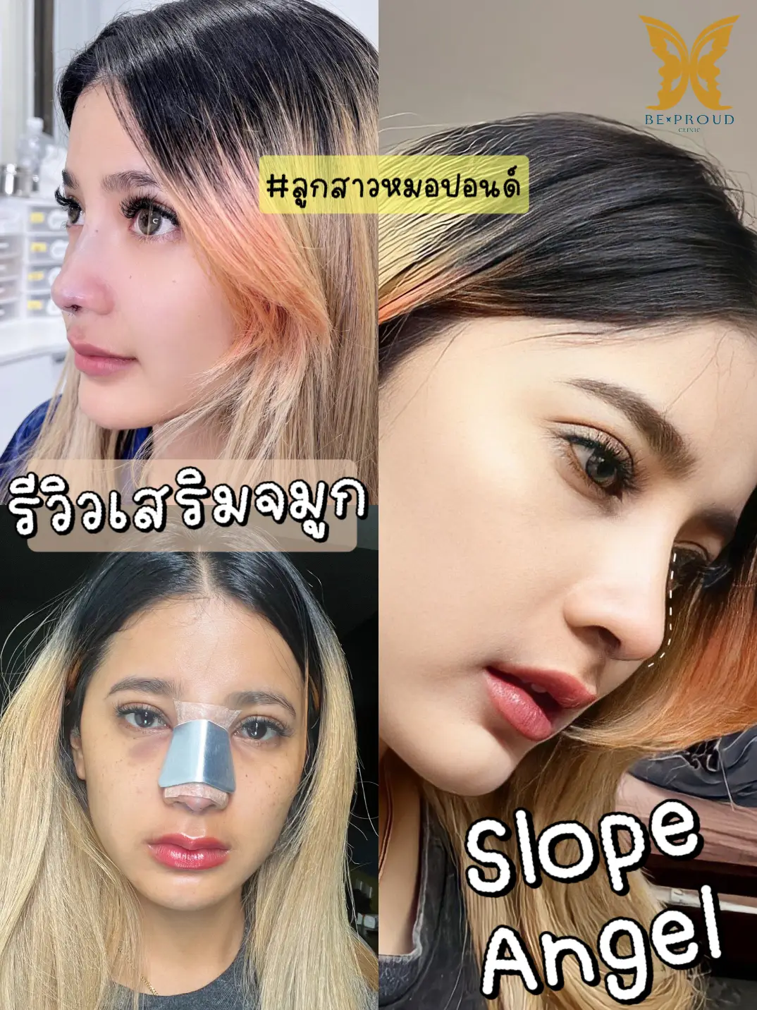 รอด Vs ไม่รอด เสริมจมูกที่บีพราวด์ คลินิก!!! | แกลเลอรีที่โพสต์โดย Beproud  Clinic | Lemon8