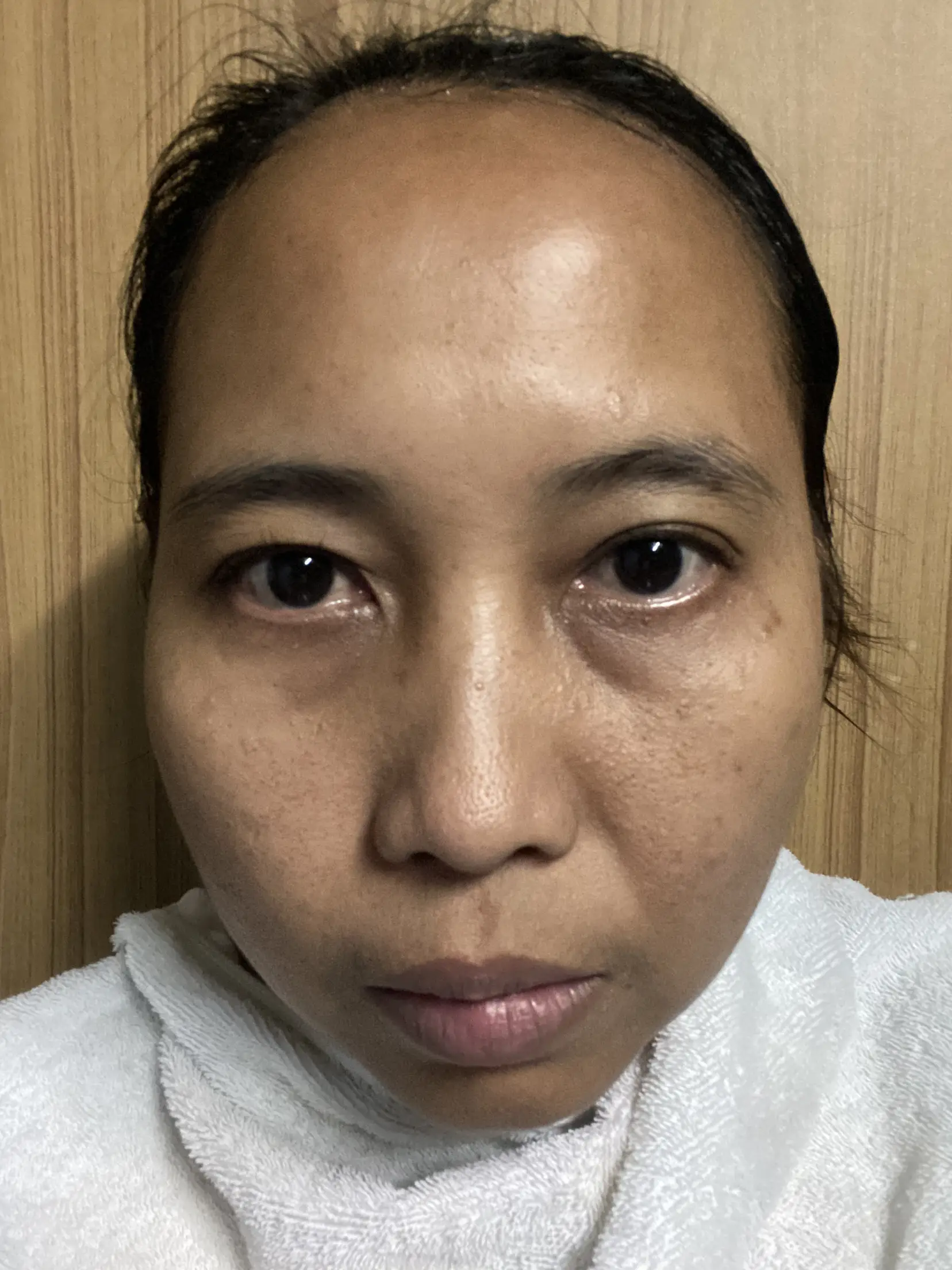 รีวิวฉีด rejuran & chanel ครบ 💉💉💉 ที่ skin club clinic แกลเลอรีที่