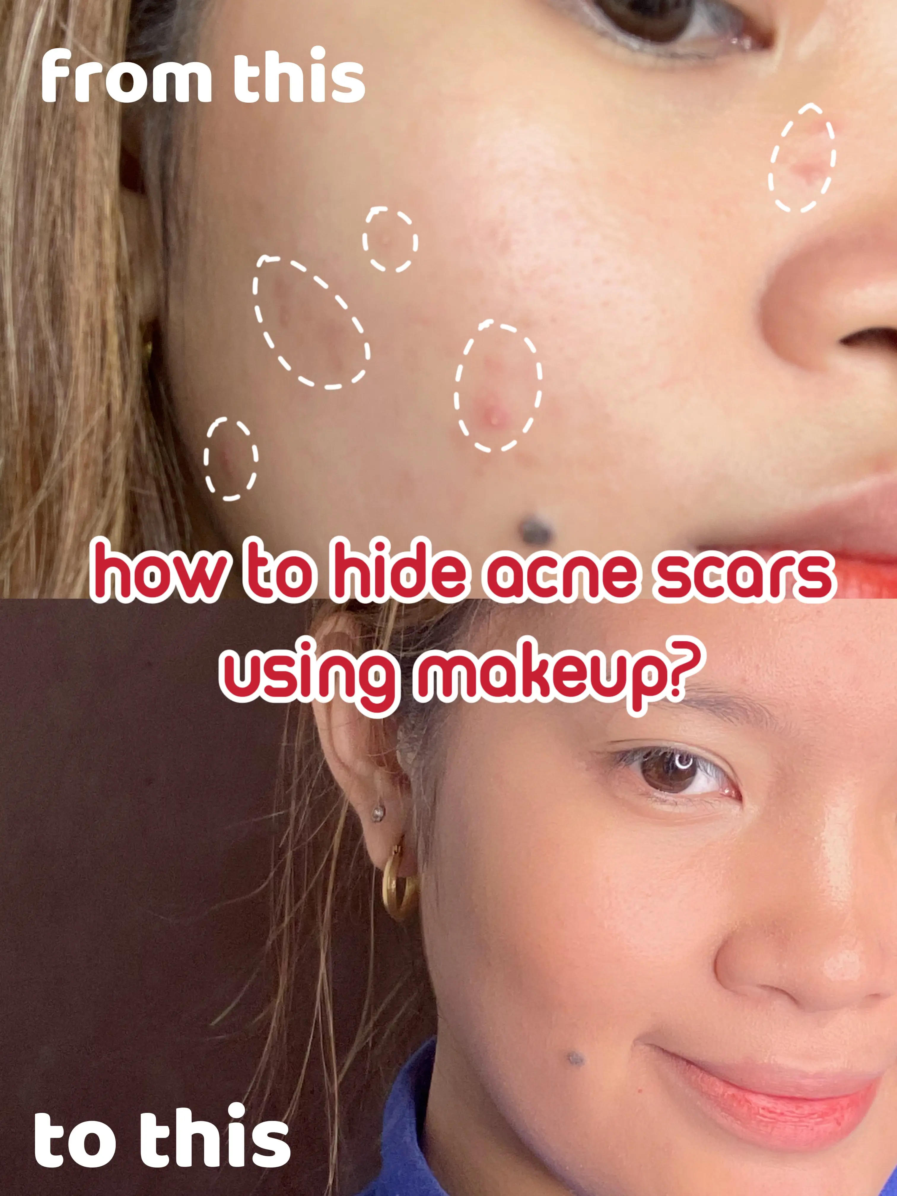 How To Hide Acne Marks Using Makeup
