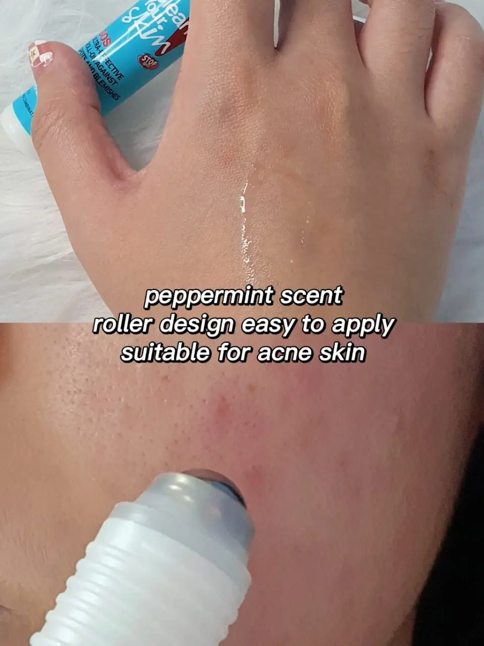 Effective Acne Roller Review‼️ | แกลเลอรีที่โพสต์โดย Carrotlobak | Lemon8