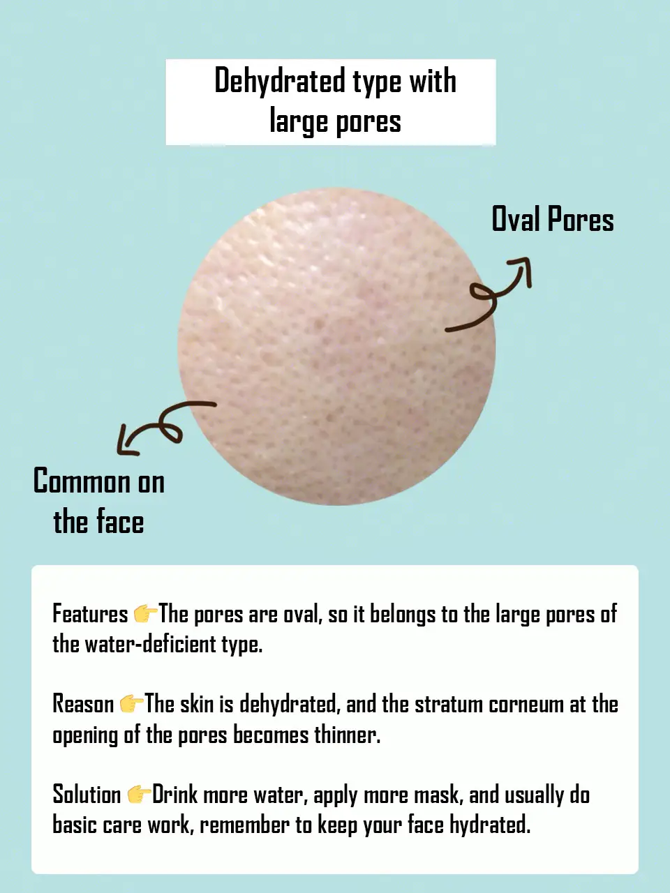 Four different types of pores and their causes💜's images(1)