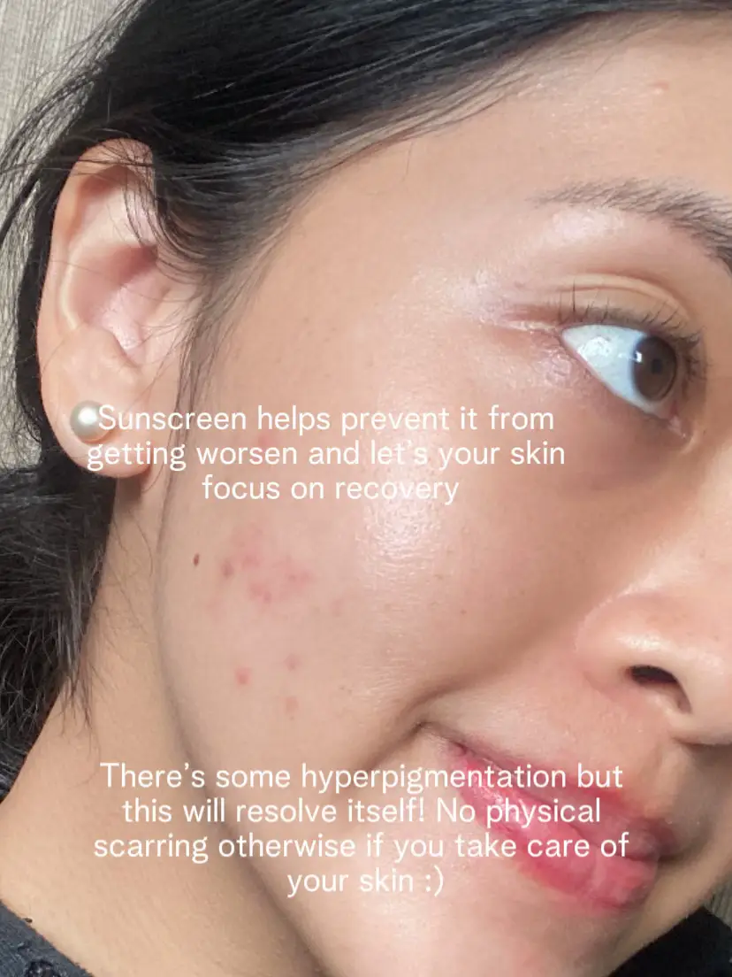 3 tricks I SWEAR BY to PREVENT acne scars 🙌's images(2)