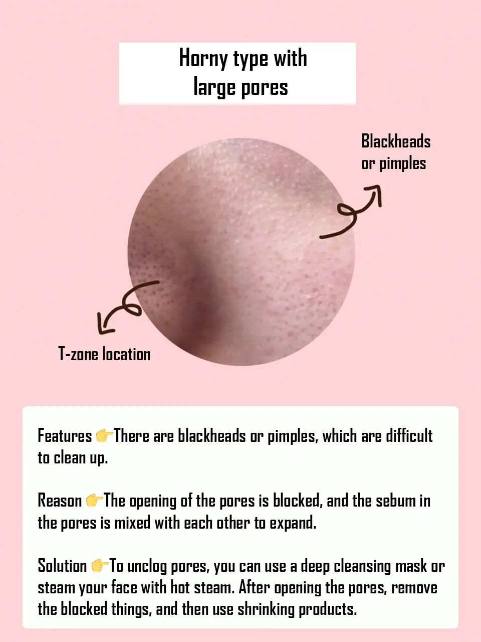 Four different types of pores and their causes💜's images(2)
