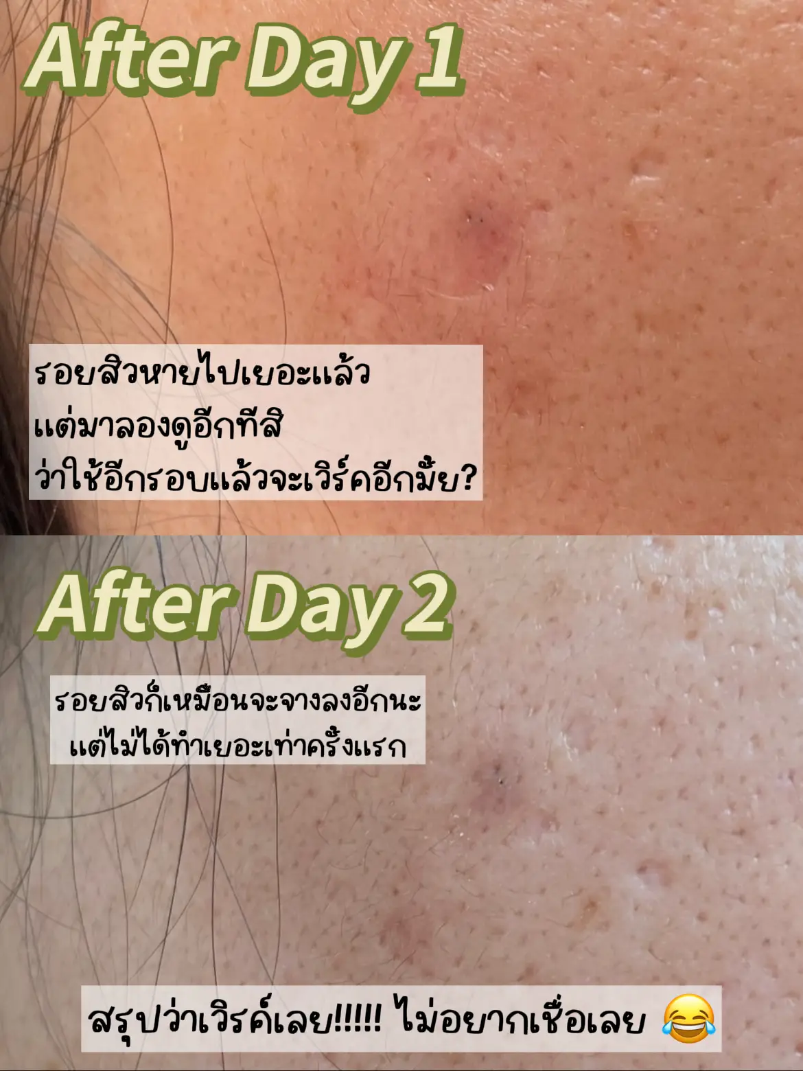 รีวิวแผ่นแปะลดรอยสิว Curesys Dark Spot AC Patch | แกลเลอรีที่โพสต์โดย ...
