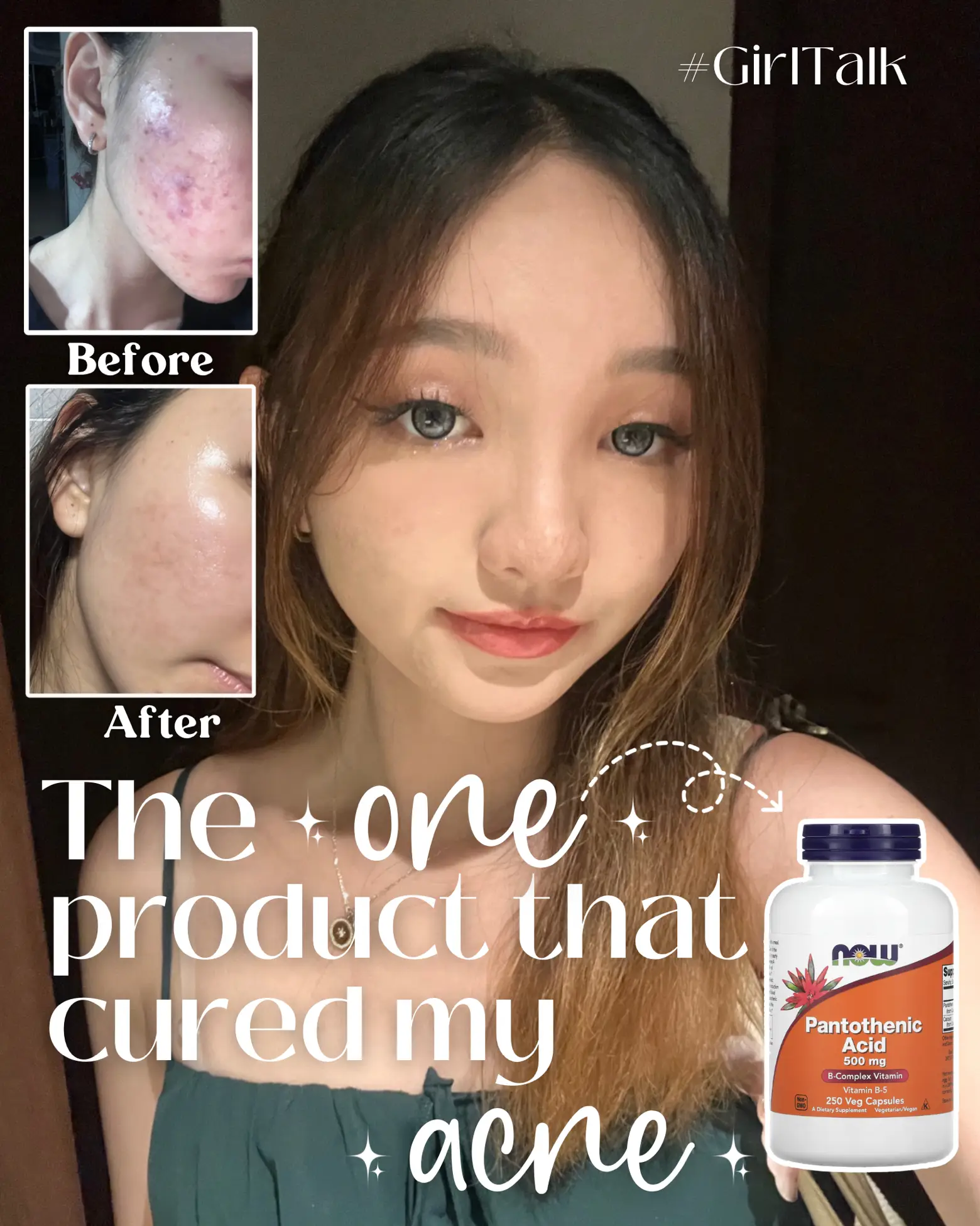 ACCUTANE DOOP THAT FINALLY CLEARED MY SEVERE ACNE🥹's images(0)