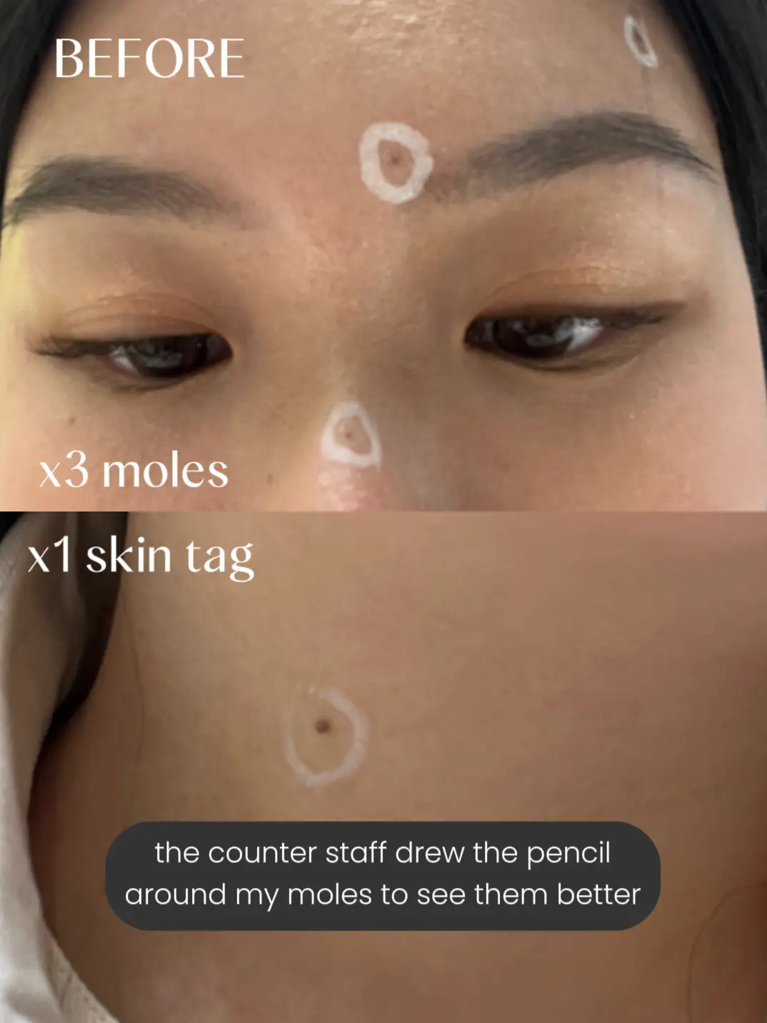 All you need to know about mole removal in Korea 🇰🇷's images(1)