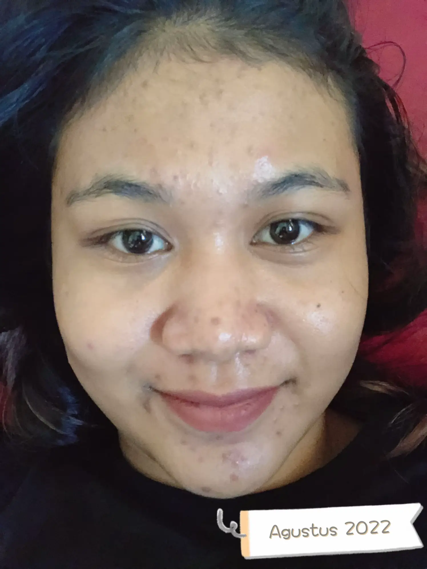 Acne Journey | Galeri diposting oleh pujia23 | Lemon8