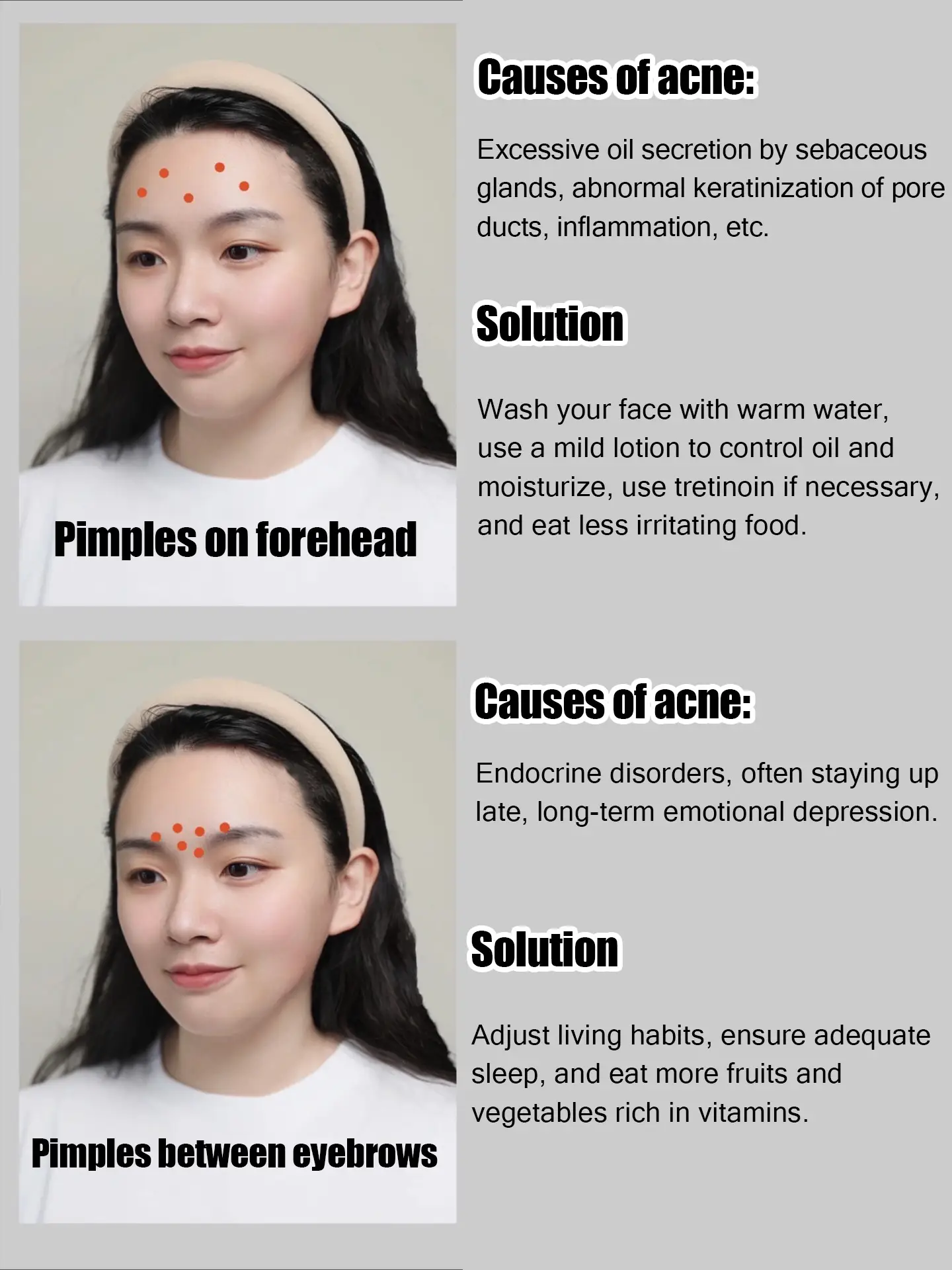 🌼🌼 Skincare routine when you have acne🌼🌼's images(1)