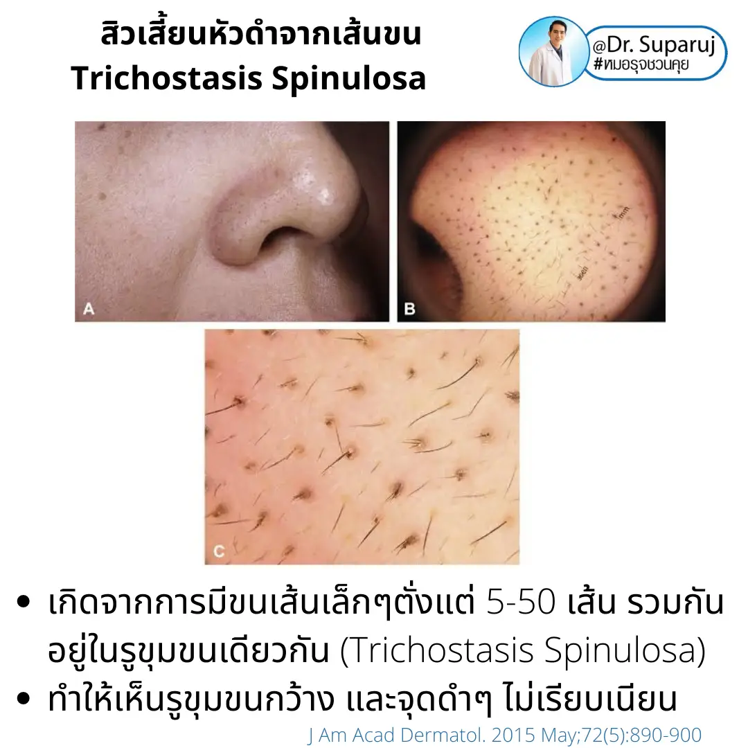 Trichostasis Spinulosa Causes