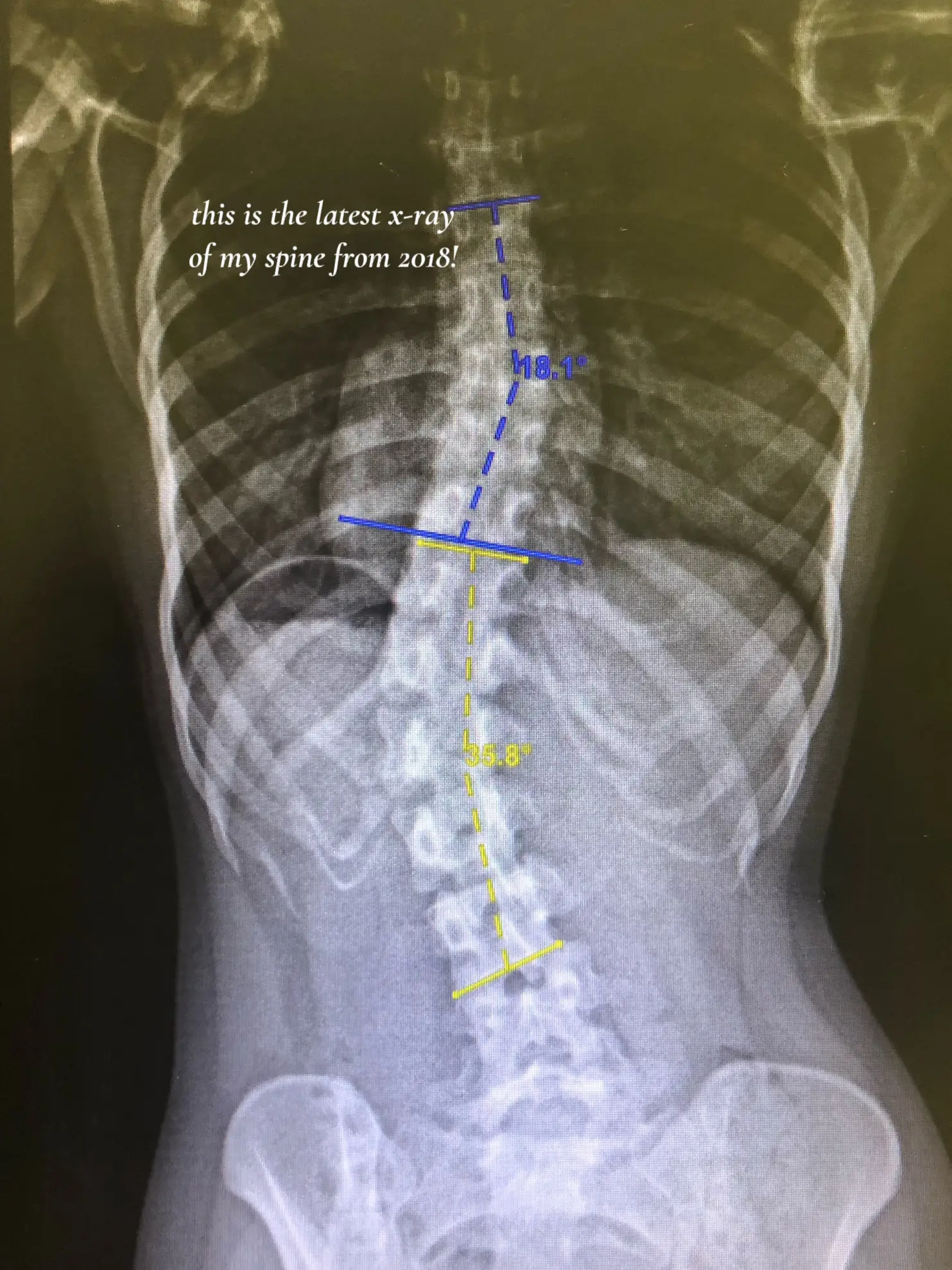 if you have scoliosis, read this!'s images(1)