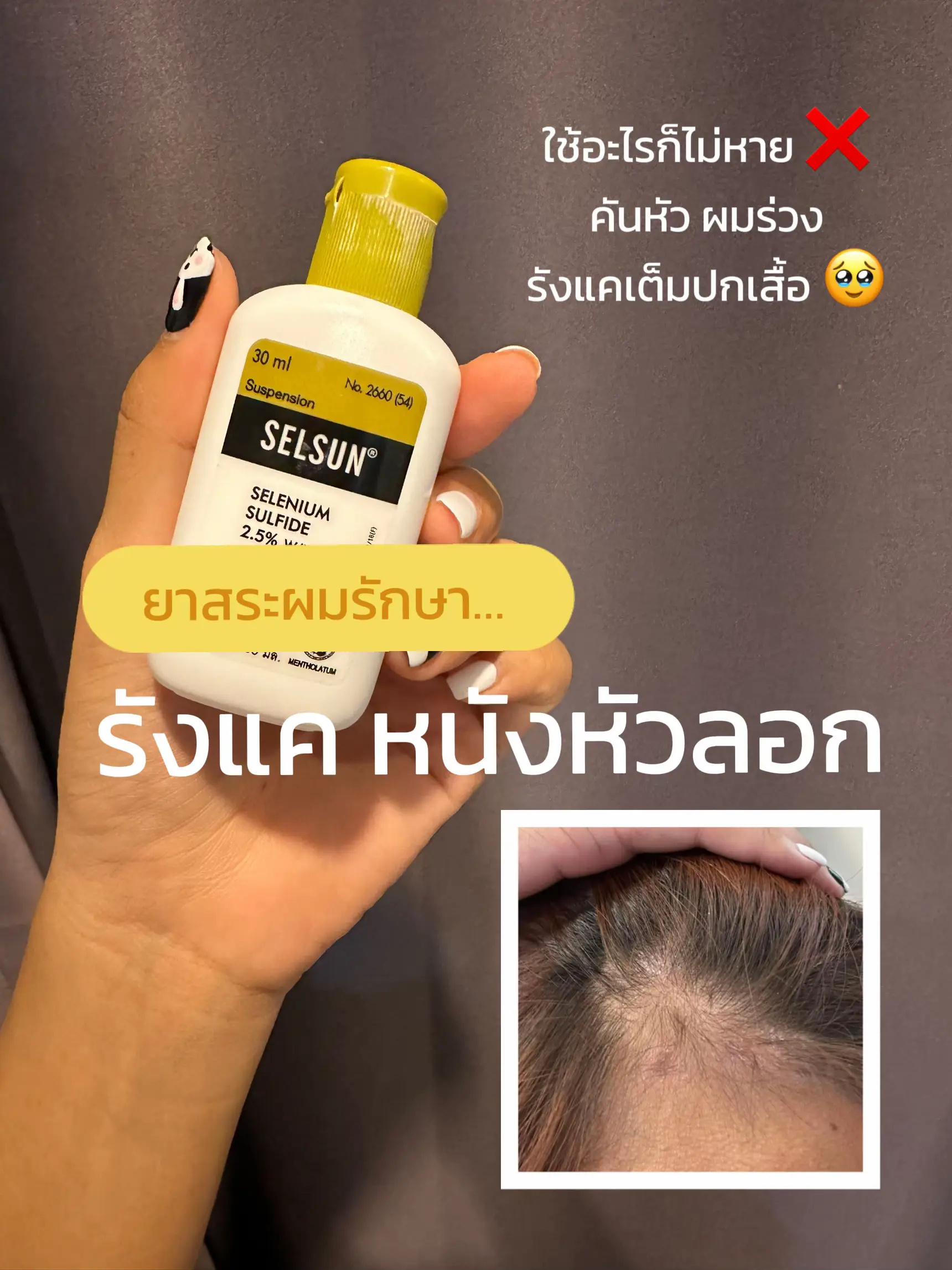 พลีชีพ!!! ป้ายยายาสระผมแก้หนังหัวลอก รังแค ✨ | แกลเลอรีที่โพสต์โดย  Kumapran'G | Lemon8