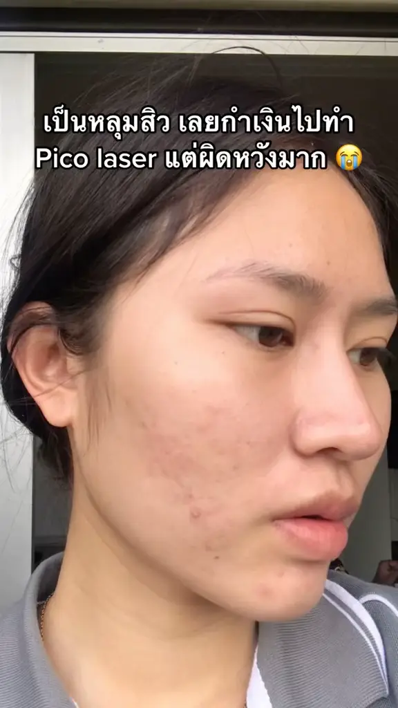 Pimple Pit Pico Laserのレビューは、この間非常に人気があります。 😭😭😭 | Rattinan Skinの投稿動画 |  Lemon8