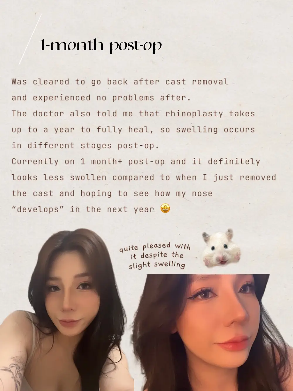 Got a nose job in Korea 🤕 (Price + Recovery!)'s images(4)