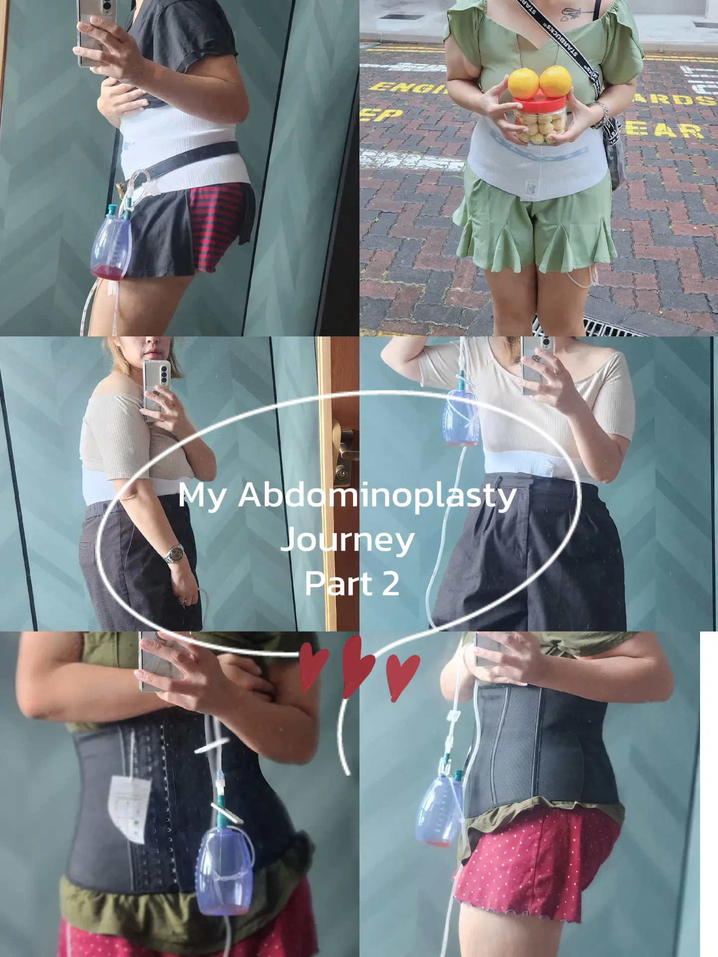 My Abdominoplasty (Tummy Tuck) Journey 2023 Part 2, Gallery posted by Nami  Mummy