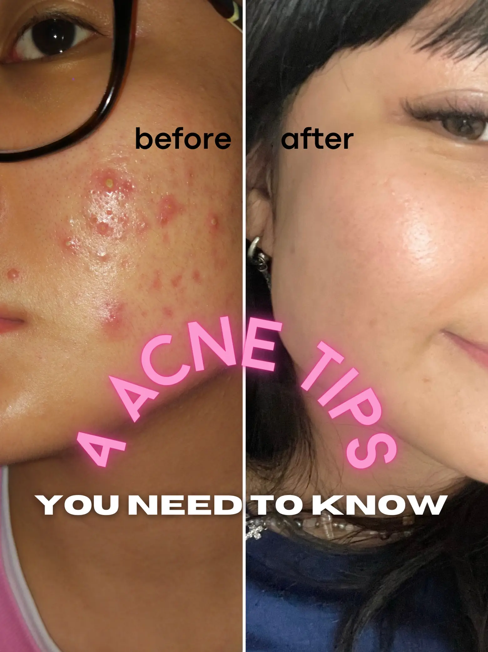 this is why you still have ACNE 😤's images