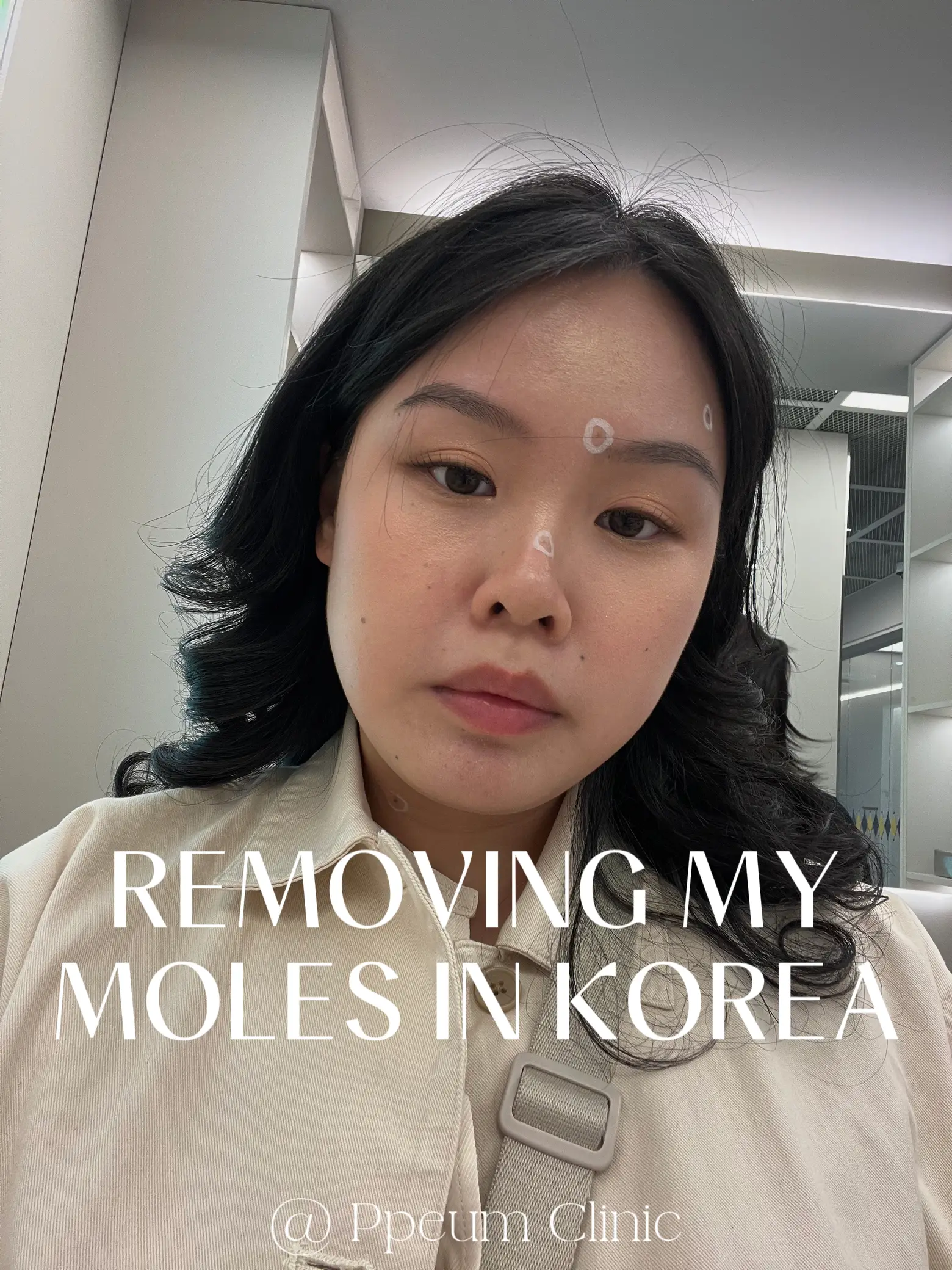 All you need to know about mole removal in Korea 🇰🇷's images(0)
