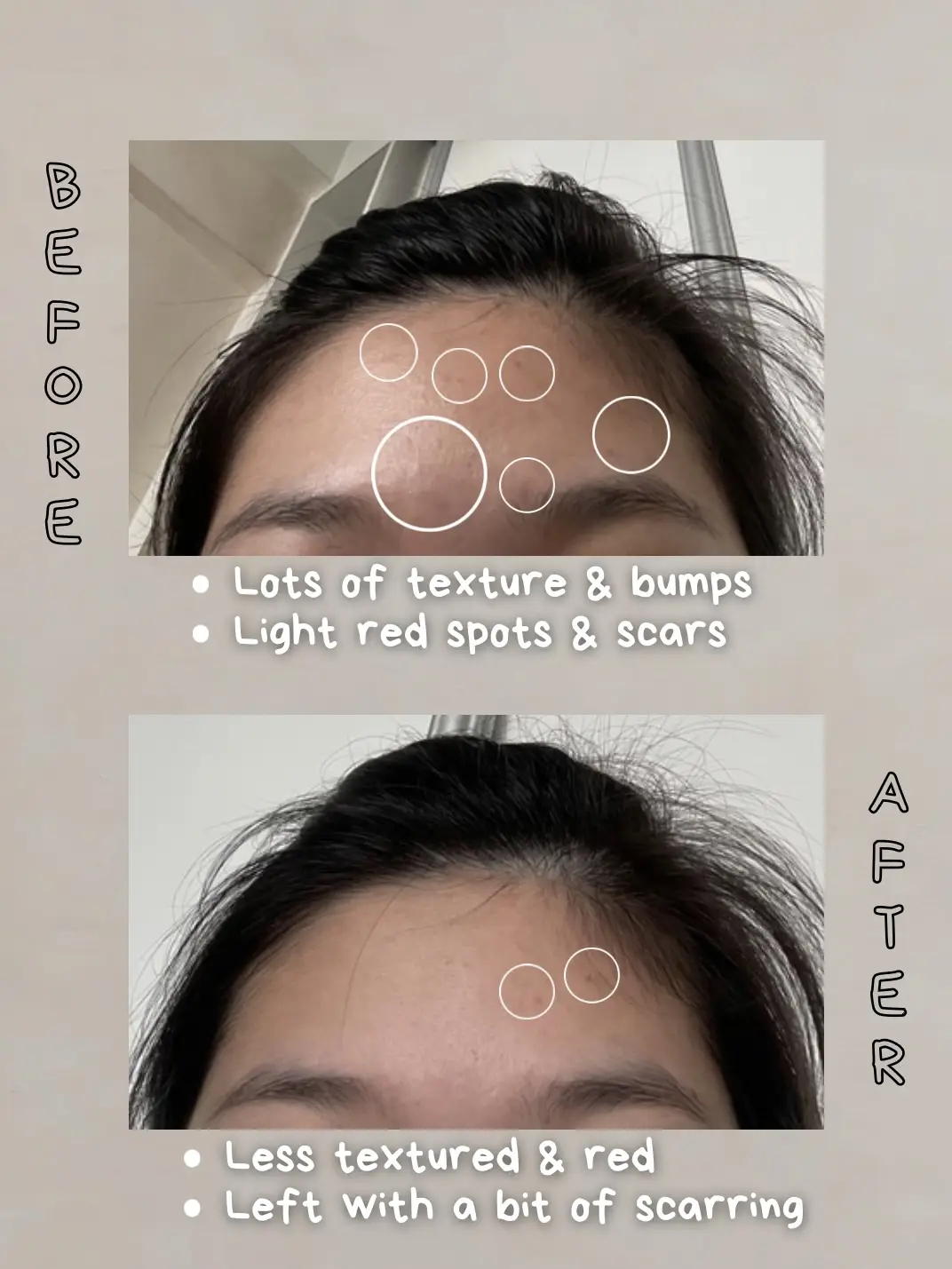 Reduce texture & acne with this!!'s images(2)