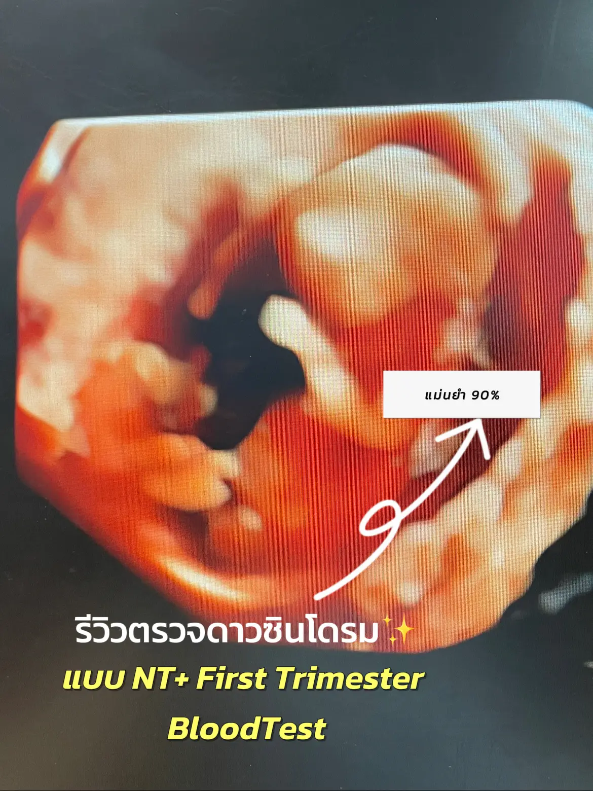 รีวิวตรวจดาวน์ซินโดรมแบบNT+First Trimester BloodTest แกลเลอรีที่โพสต์