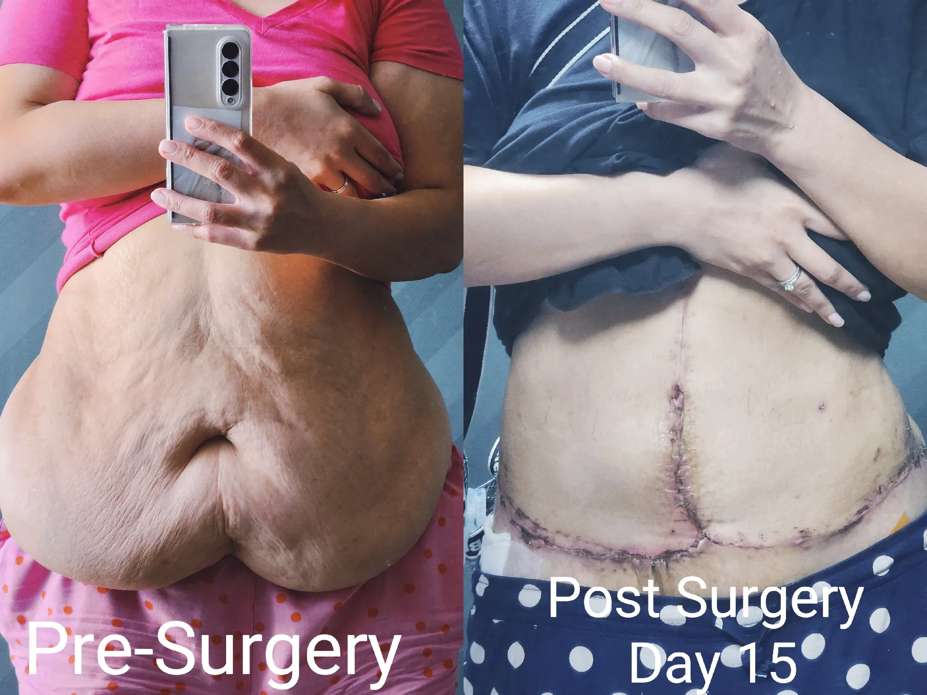 My Abdominoplasty (Tummy Tuck) Journey 2023 Part 2, Gallery posted by Nami  Mummy