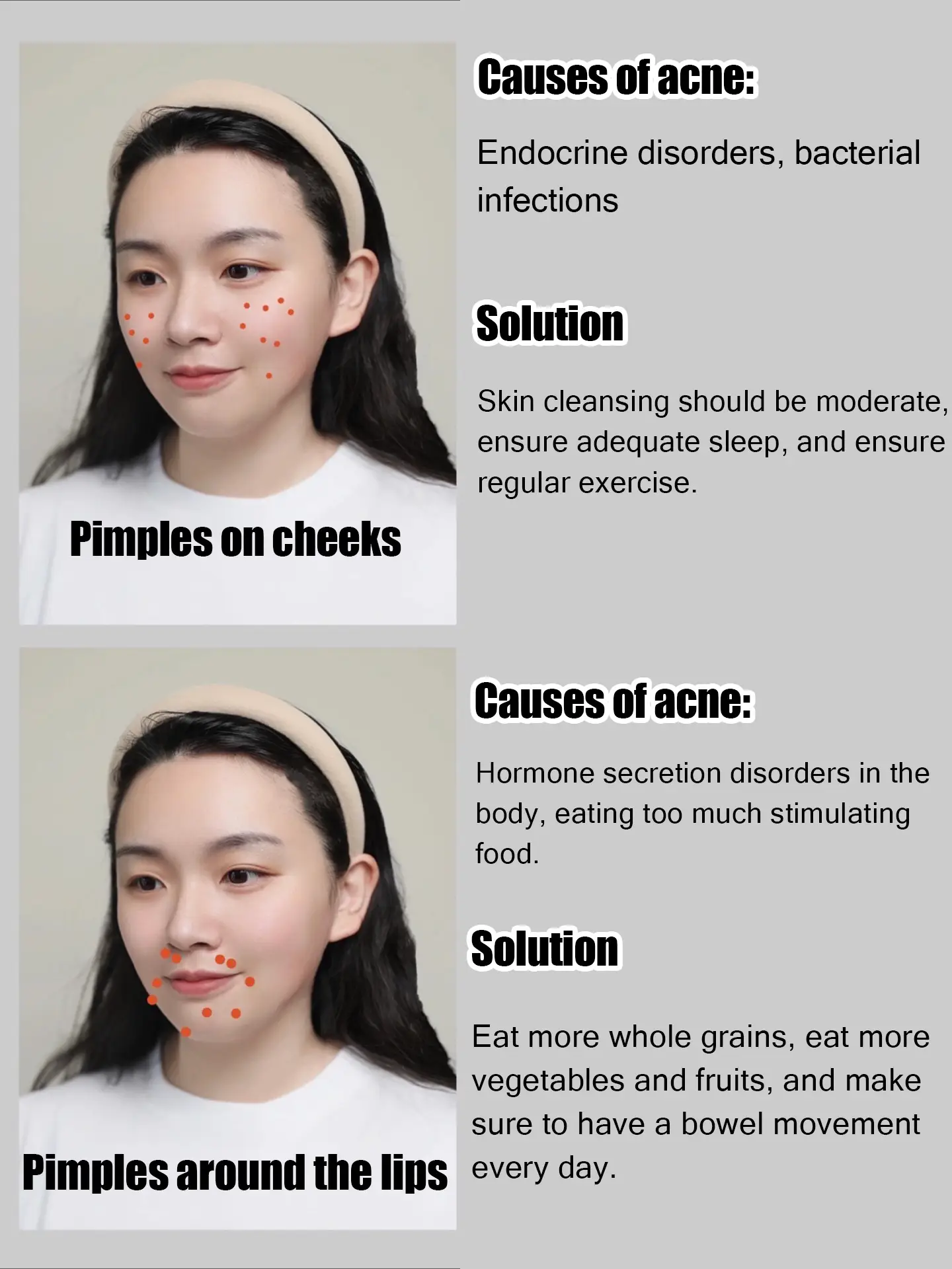 🌼🌼 Skincare routine when you have acne🌼🌼's images(4)