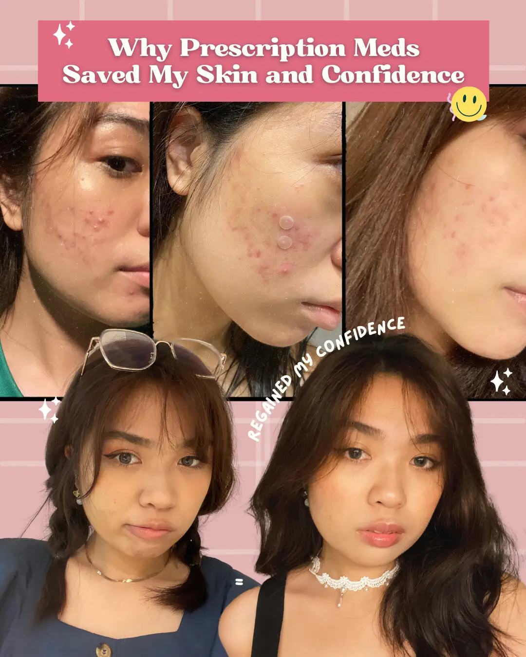 Cleared My Acne & Regained Confidence In 1 Mth 🫶🏻's images(0)