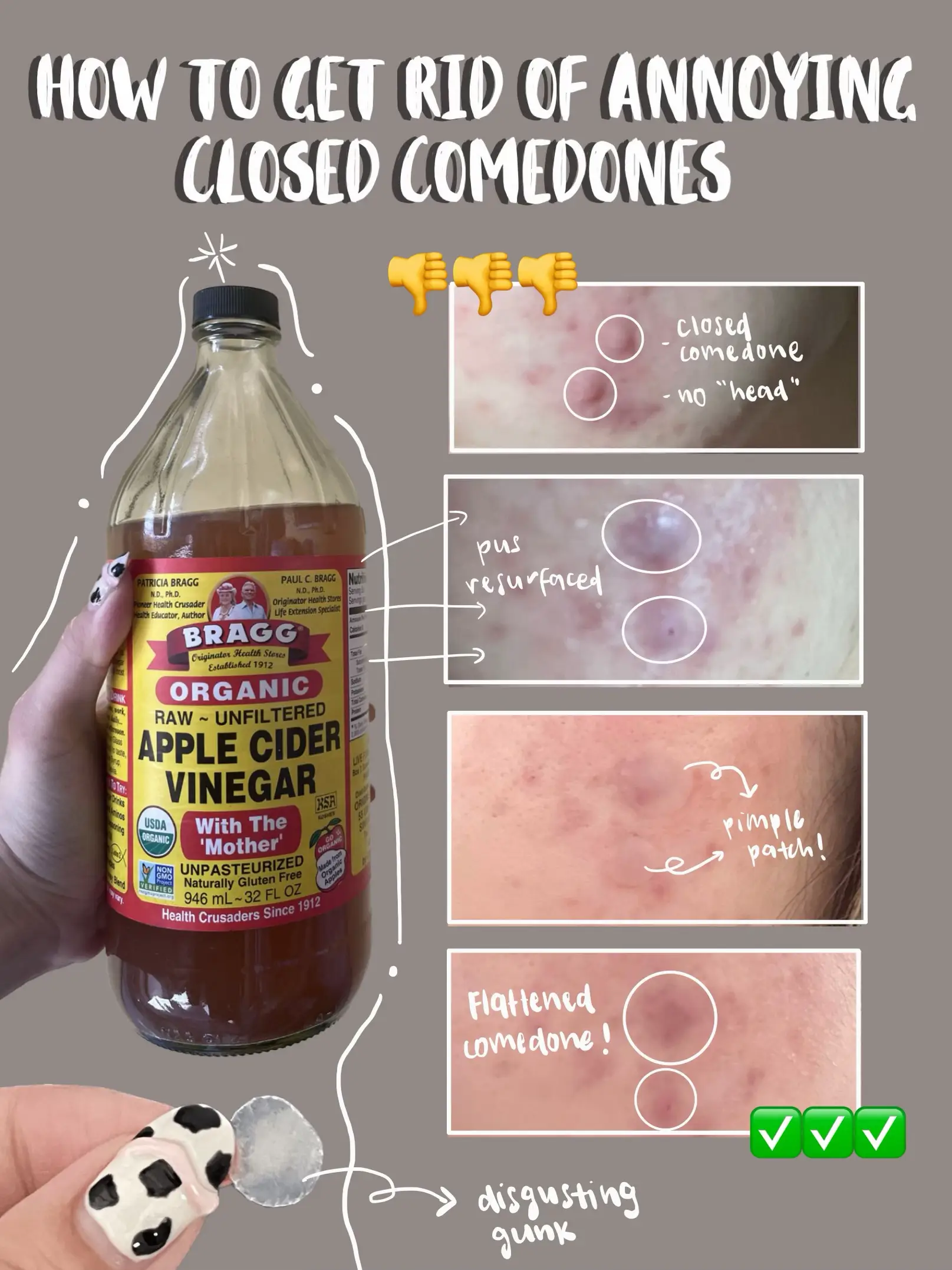 ACV | GET RID OF CLOSED COMEDDONES OVERNIGHT ! 👹👹👹's images(0)