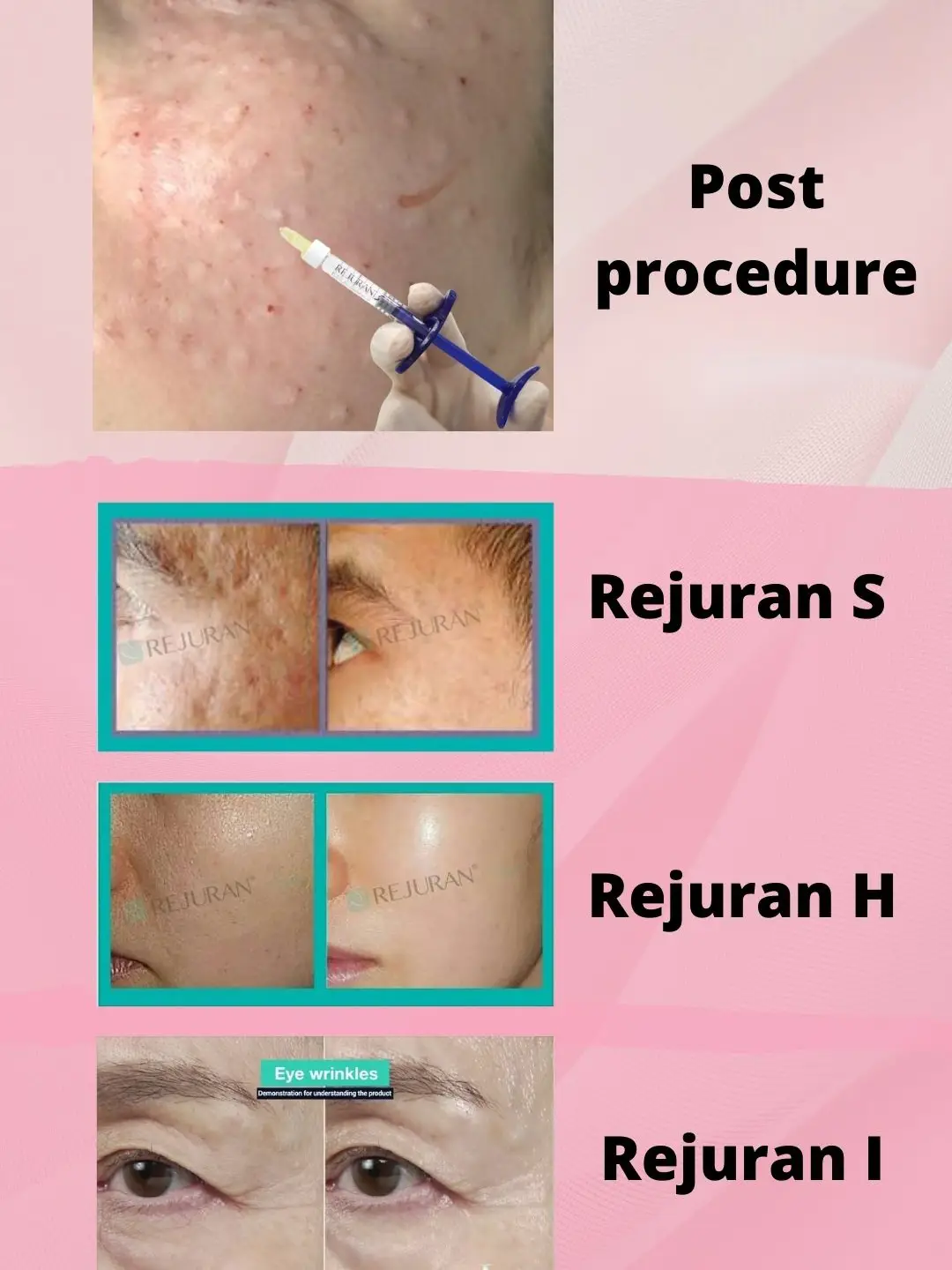 🌟Rejuran : Anti-aging | Galeri disiarkan oleh drteo_aesthetic | Lemon8