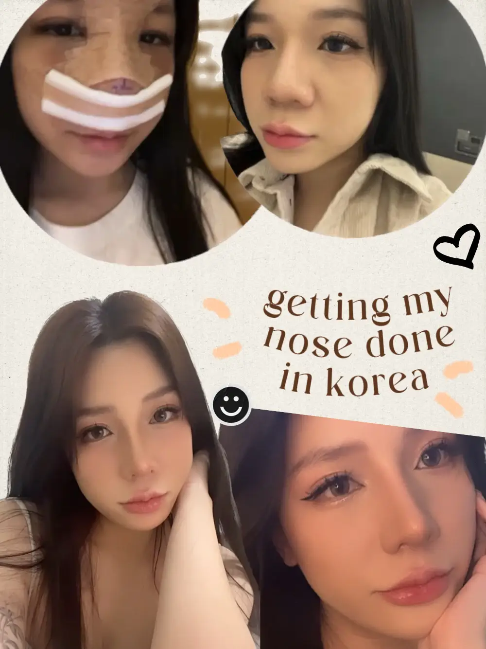 Got a nose job in Korea 🤕 (Price + Recovery!)'s images(0)